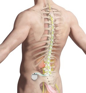https://www.precisionpainmd.com/3d-images/spinal-cord-stimulator.jpg